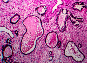 Micrografia luminosa che mostra la diffusione delle cellule tumorali dell'endometrio. Credit: Kateryna Kon/Science Source