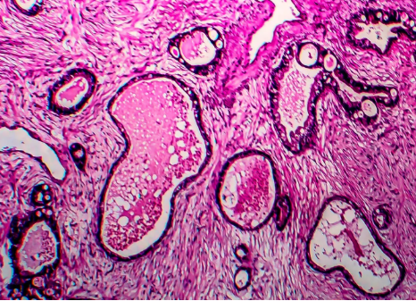 Micrografia luminosa che mostra la diffusione delle cellule tumorali dell'endometrio. Credit: Kateryna Kon/Science Source